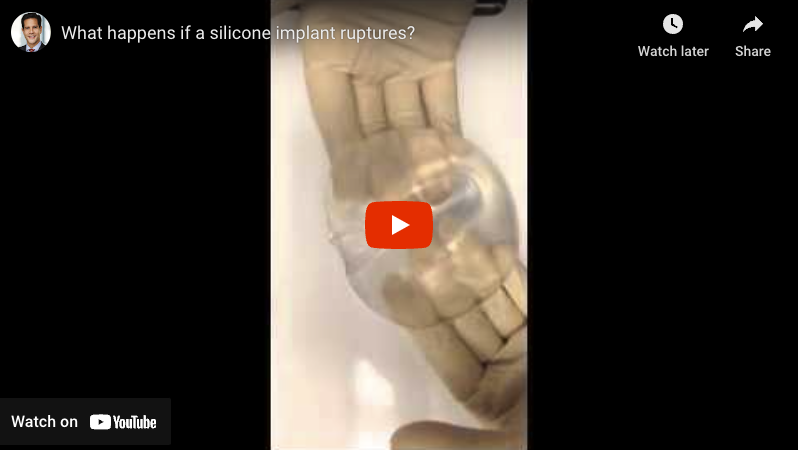 What happens if a silicone implant ruptures? (Video)